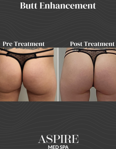 Butt Enhancement