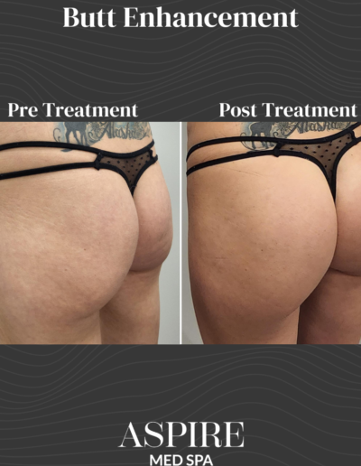 Butt Enhancement