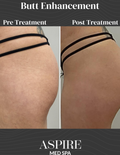 Butt Enhancement
