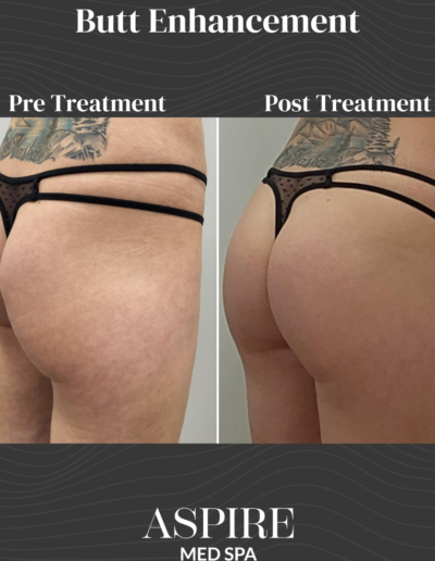 Butt Enhancement