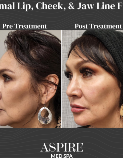 Dermal Filler
