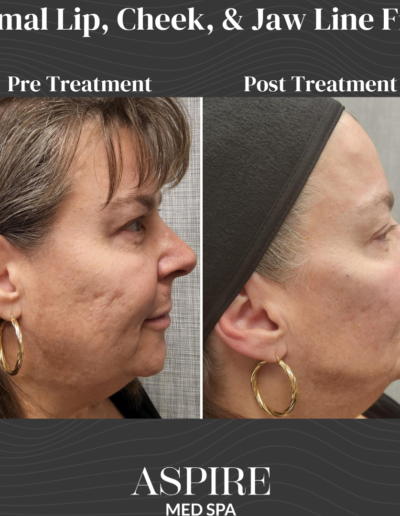 Dermal Filler