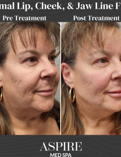 Dermal Filler