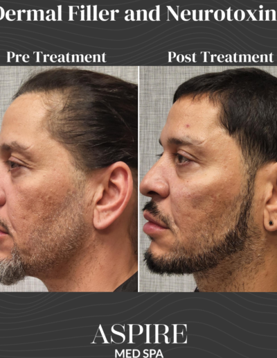 Dermal Filler and Neurotoxins