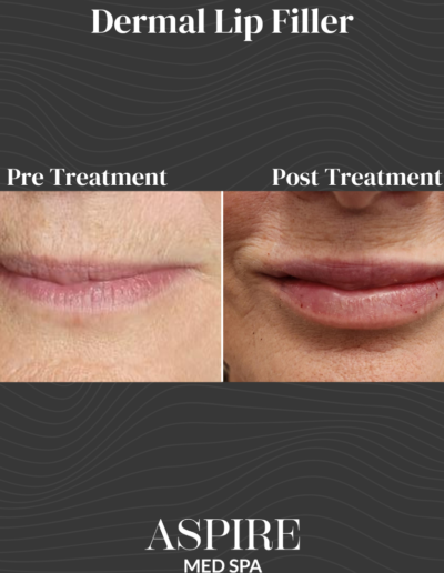 Dermal Lip Filler