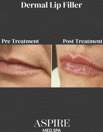 Dermal Lip Filler