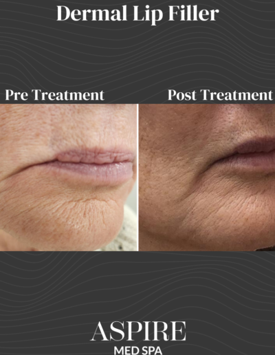 Dermal Lip Filler