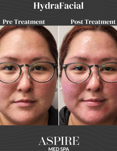 HydraFacial