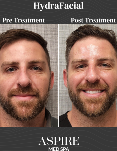 HydraFacial