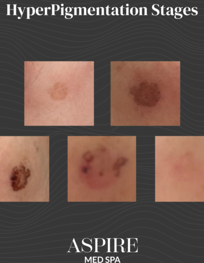 HyperPigmentation