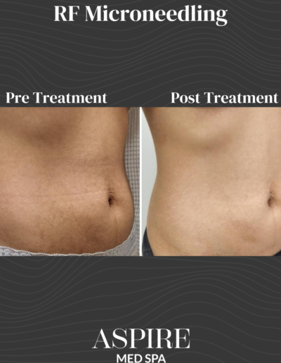 RF Microneedling