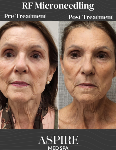 RF Microneedling