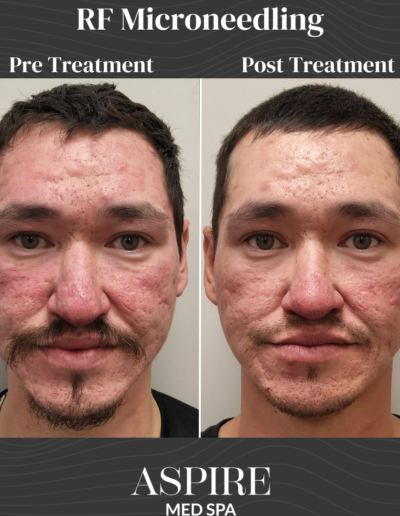 RF Microneedling
