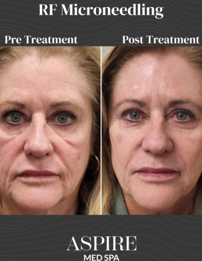RF Microneedling