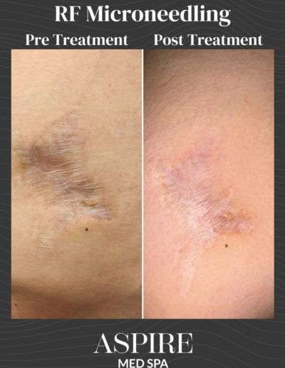 Microneedling