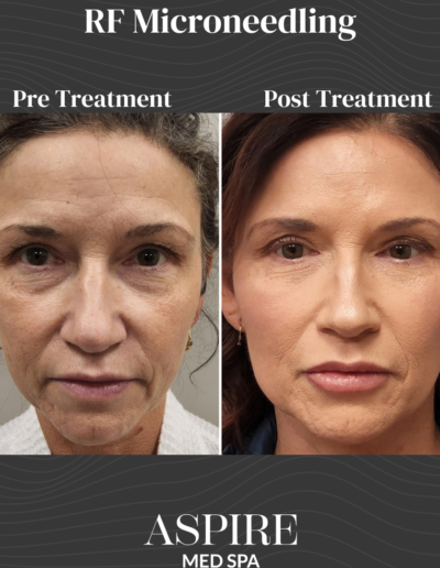 RF Microneedling
