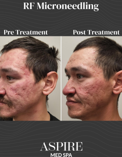 RF Microneedling