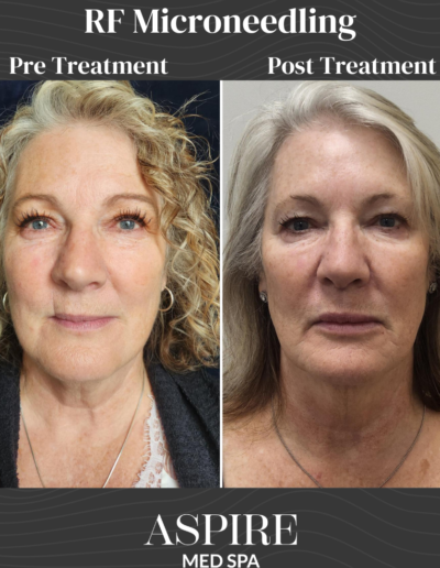 RF Microneedling