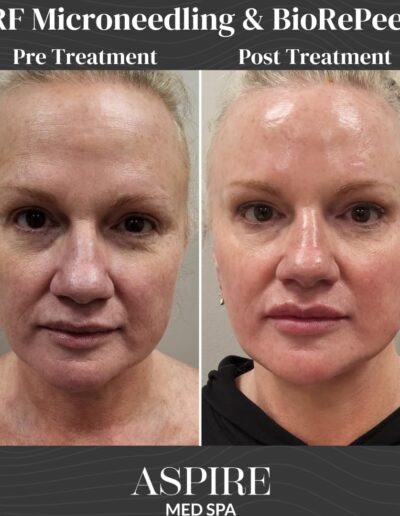 before and after biopeeling images