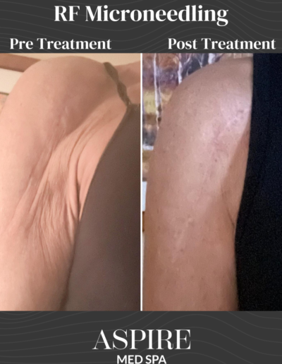 Microneedling Scar