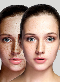 Pigmentation Correction