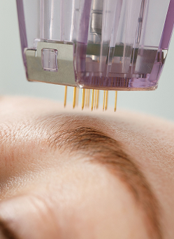 Radiofrequency